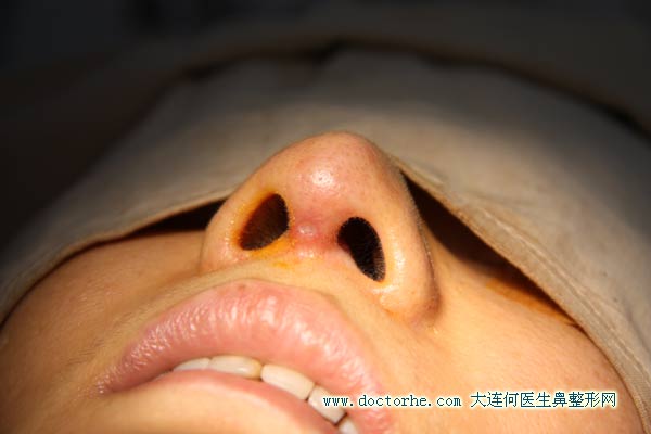 L型硅胶隆鼻失败取出硅胶假体